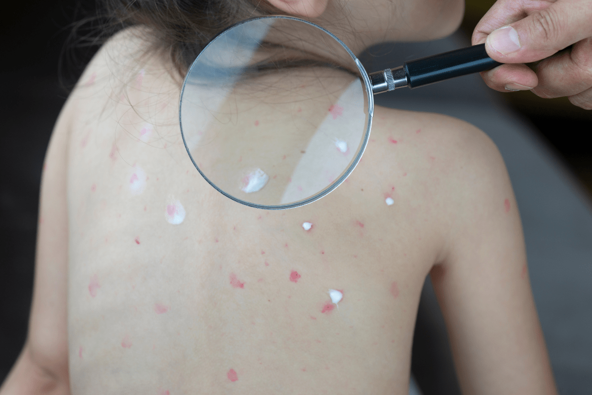 Chickenpox Vaccine Hackney Islington Murray S Pharmacy   Chickenpox Vaccine 