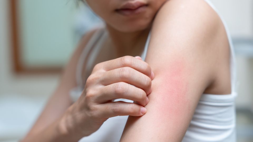 benadryl cream
