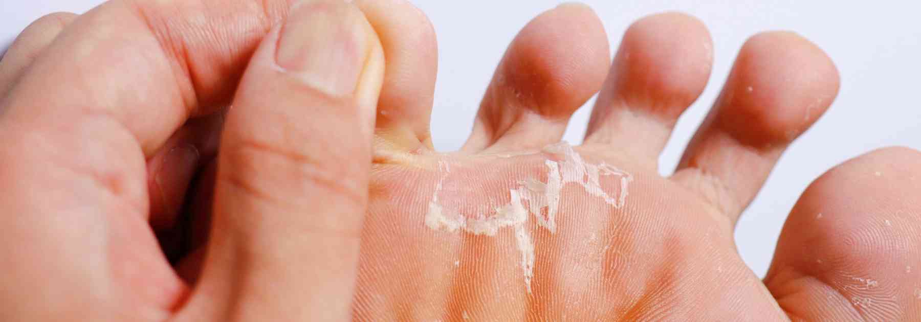 athlete's foot cream london