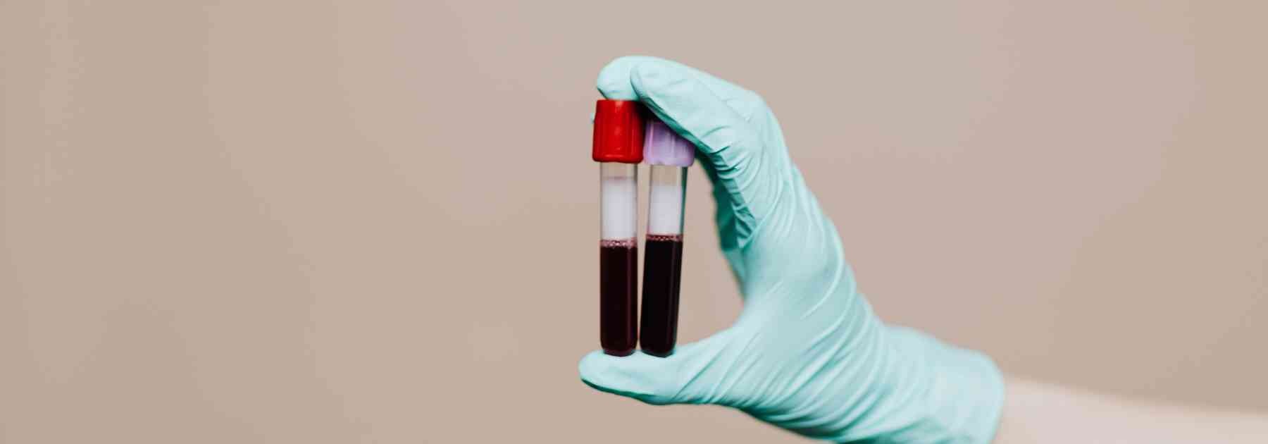 person wearing medical glove holding blood tests