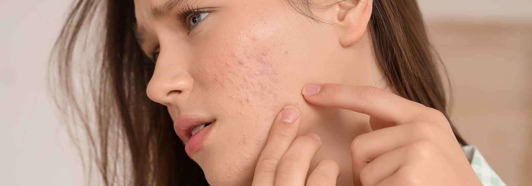 Acne issues in london