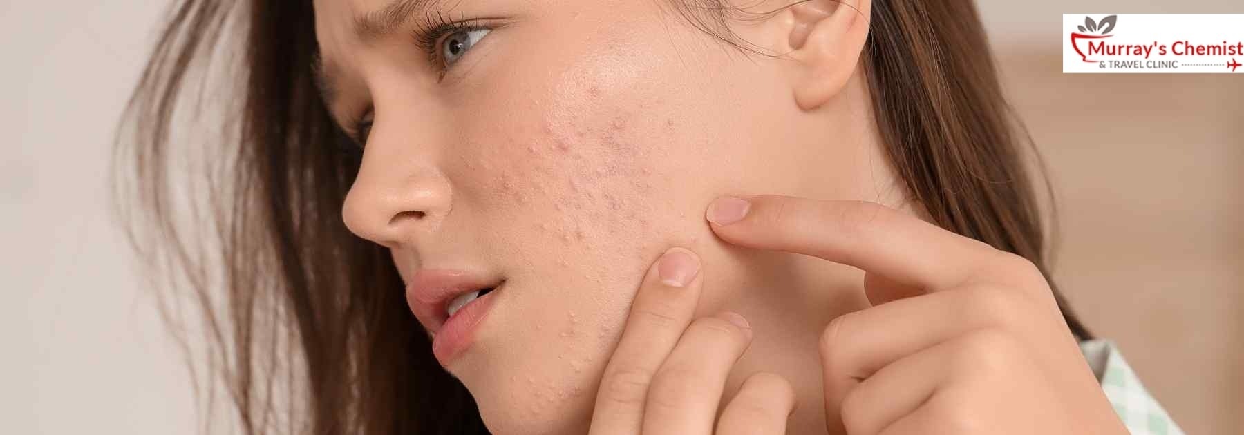 Acne issues in london